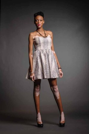 La modelo que tiene una enfermedad degenerativa llamada vitiligo, sufrió acoso escolar por parte de sus compañeros, quienes la llamaban "zebra".