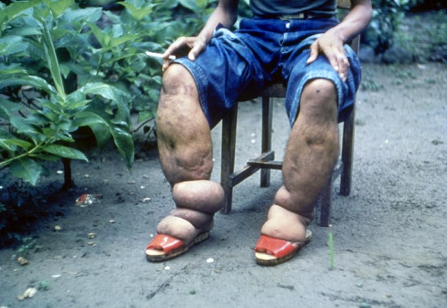 Esta infección puede llevar a una alteración del sistema linfático y resultar en linfedema crónico, así como en el crecimiento anormal de las partes del cuerpo. Esta enfermedad causa dolor y discapacidad grave, y suele conllevar a la estigmatización y a la exclusión social.
