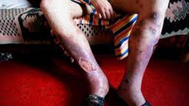 Primer adicto a krokodil en México