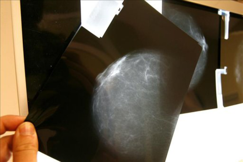 Supervivientes al cáncer de mama HER2