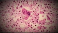 measles under a microscope
