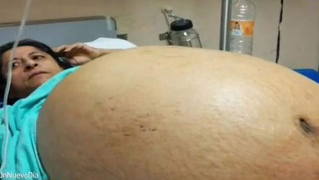 tlmd_tumor_gigante_ok