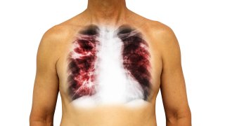 tuberculosis-generica-shutterstock_693801163