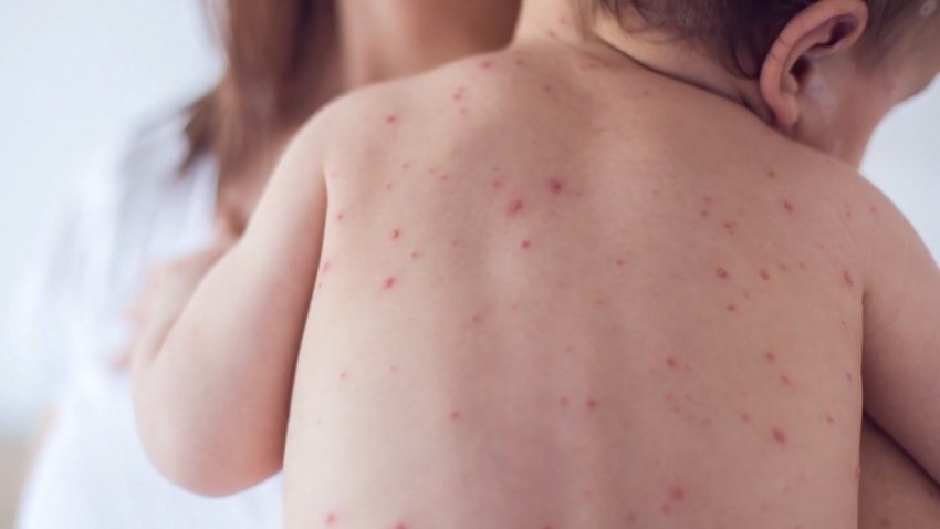 Lo que necesitas saber sobre la vacuna triple vírica