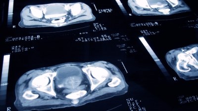 ¿Qué es el cáncer de próstata? Lo que debes saber sobre la enfermedad