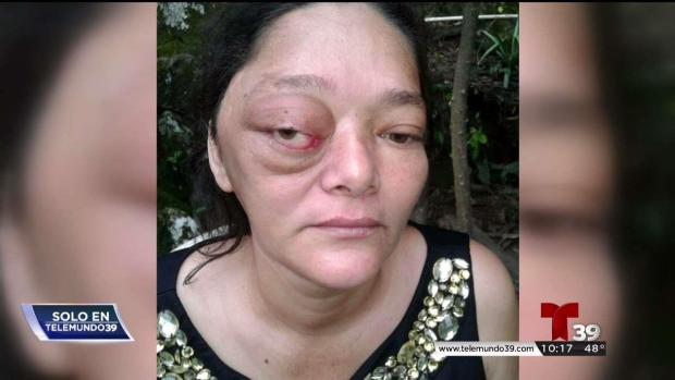 Un tumor roba la visión a una madre hondureña