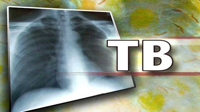Estudiante con tuberculosis